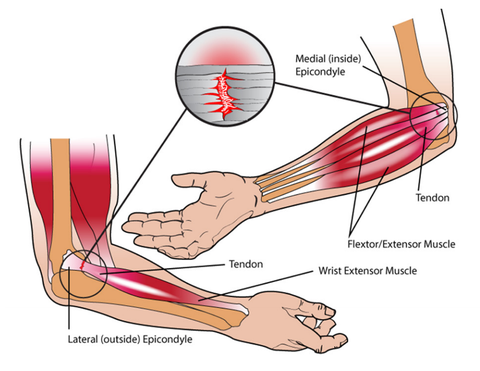 Five Stretches for Elbow & Wrist Pain – Stuart Hinds Performance Therapy