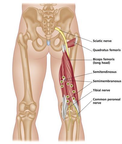 Common Sports Injuries: Treating the Hamstrings