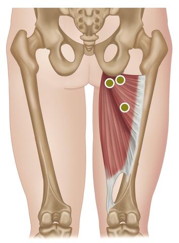 Treating the Hip Adductors