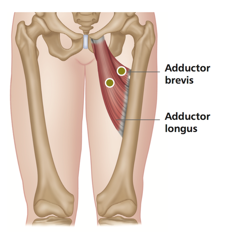 Tendinitis of the Hip Adductors