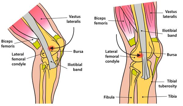 Recognising and Treating Iliotibial Band Syndrome