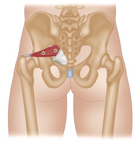 Treating Sciatica using Trigger Point Therapy