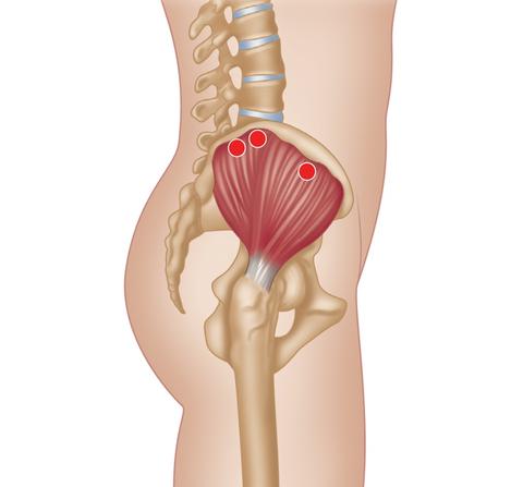 Treating Trigger Points in the Glutes