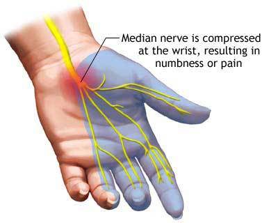 Self Help Tips for Treating Carpal Tunnel Syndrome